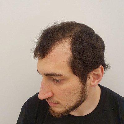 До и после проведения процедур