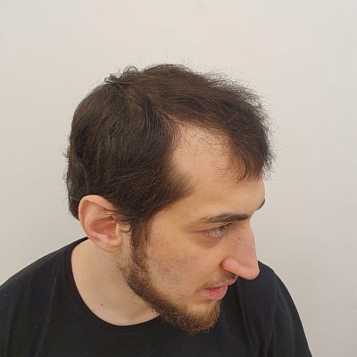 До и после проведения процедур