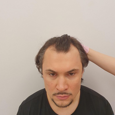 До и после проведения процедур